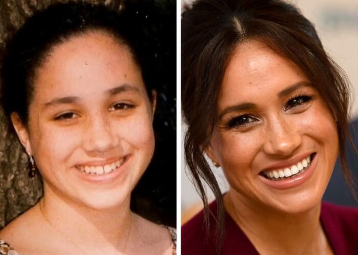 Celebrities Who Changed Their Teeth, Meghan Markle