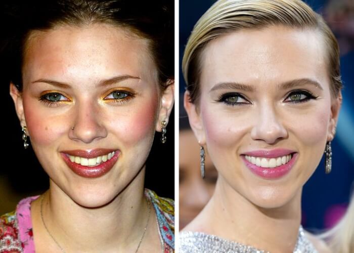 Celebrities Who Changed Their Teeth, Scarlett Johansson