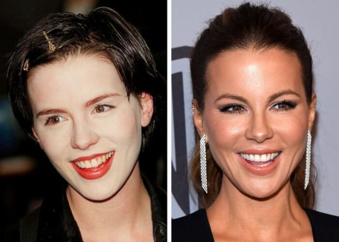 Celebrities Who Changed Their Teeth, Kate Beckinsale