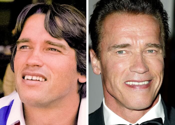 Celebrities Who Changed Their Teeth, Arnold Schwarzenegger