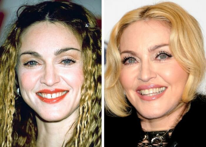 Celebrities Who Changed Their Teeth, Madonna