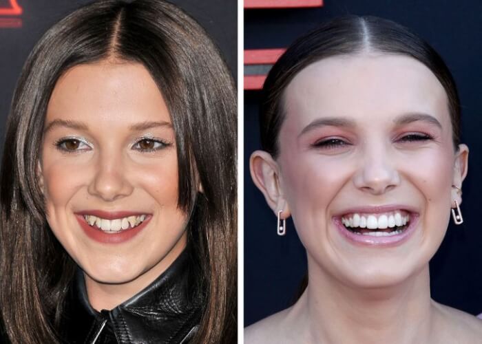 Celebrities Who Changed Their Teeth, Millie Bobby Brown