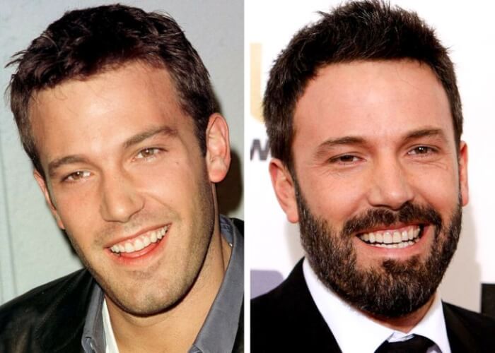 Celebrities Who Changed Their Teeth, Ben Affleck