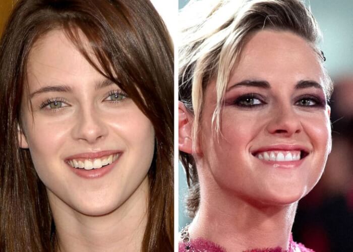 Celebrities Who Changed Their Teeth, Kristen Stewart