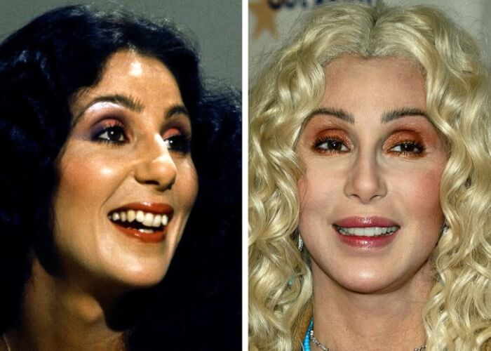 Celebrities Who Changed Their Teeth, Cher