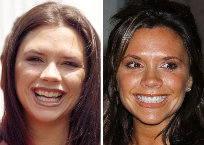 Celebrities Who Changed Their Teeth