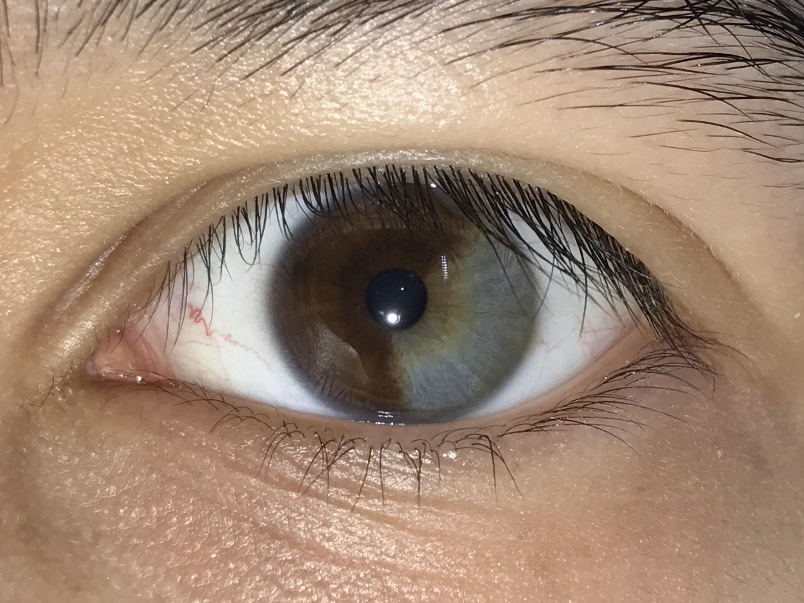 2-color eyes