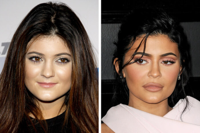 Celebrities Who Said Yes To Botox