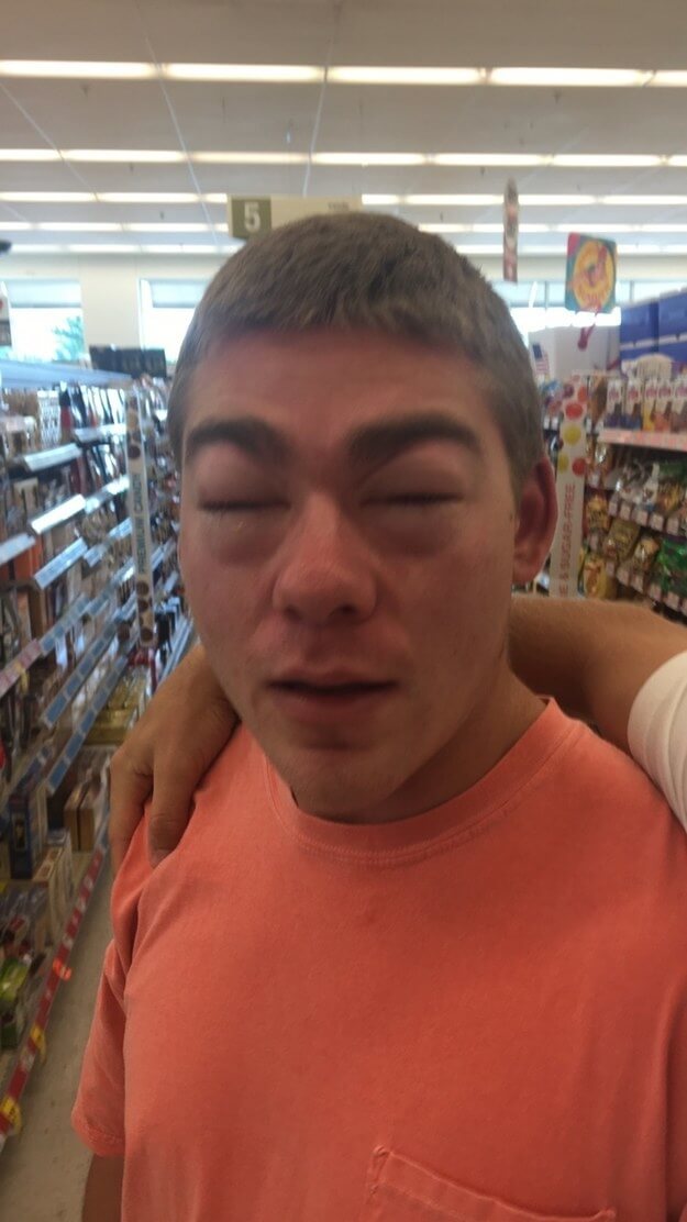 Worst Allergic Reactions
