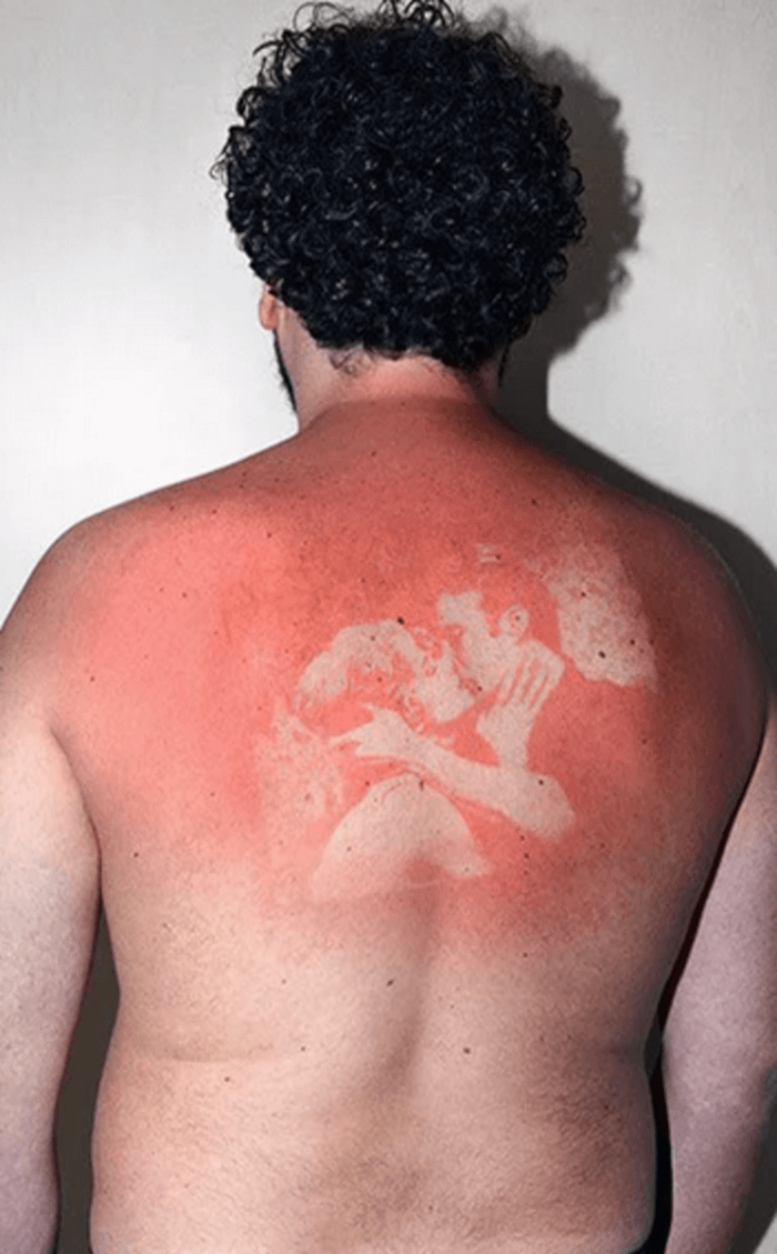 Worst sunburns 10