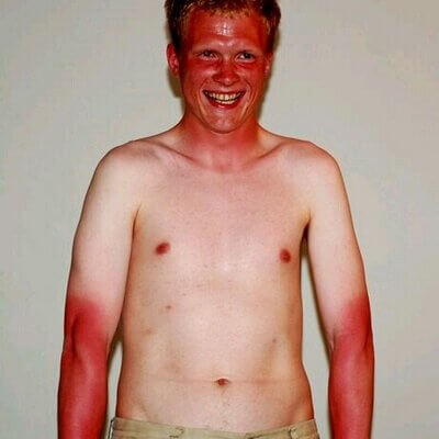 Worst sunburns 11