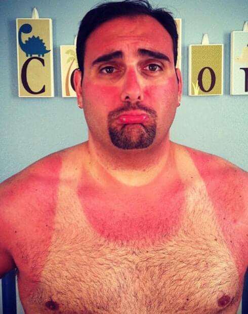 Worst sunburns 12