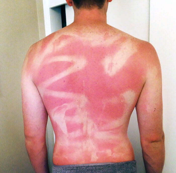 Worst sunburns 13