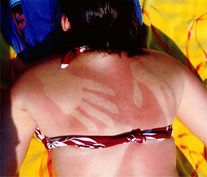 Worst sunburns 16