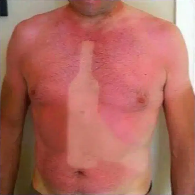 Worst sunburns 18
