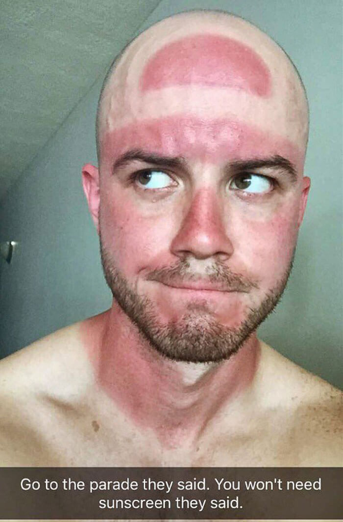 worst sunburns 1