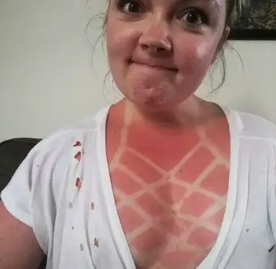 Worst sunburns 5