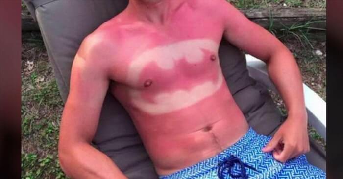 Worst sunburns 6