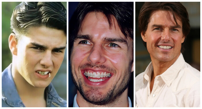 celebrities who underwent minor changes  Tom Cruise