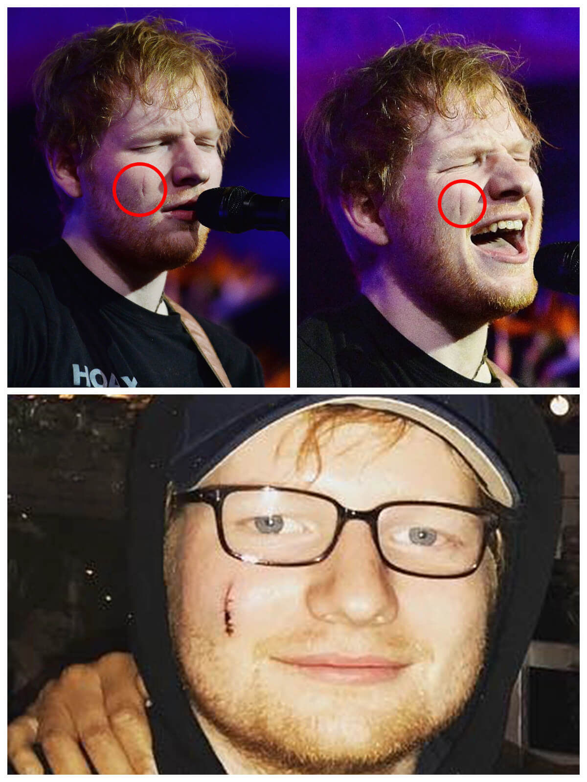 celebrities who proudly show their imperfections Ed Sheeran