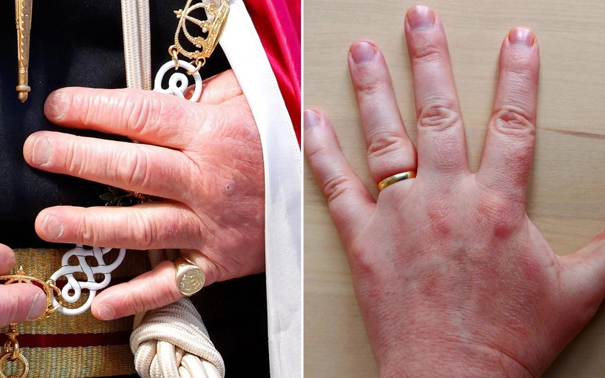 The Reason Behind King Charles Fingers Condition - king charles sausage hands