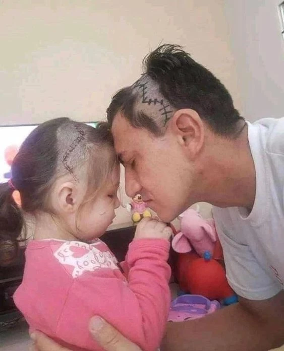 This father tattooed his skull to support his young daughter after a skull reconstruction surgery