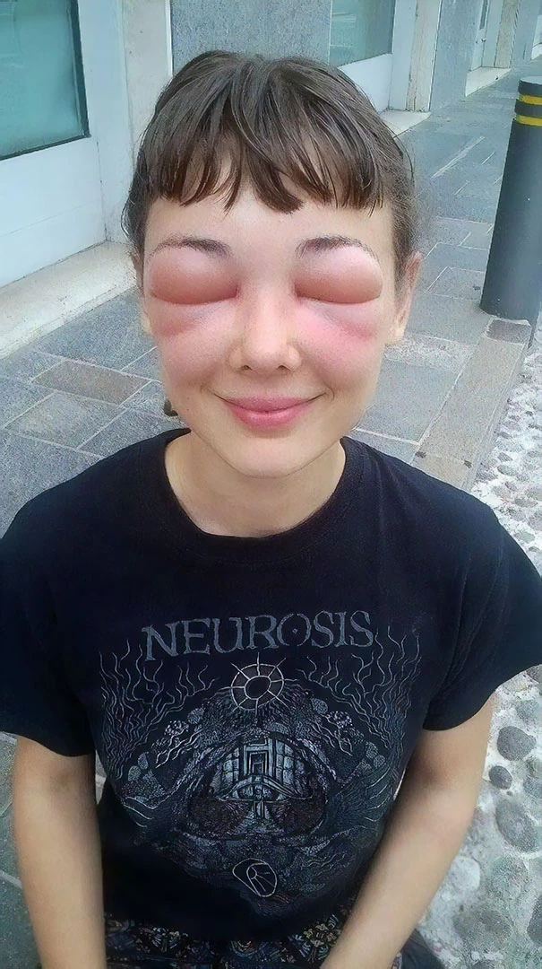She found out she was allergic to bees